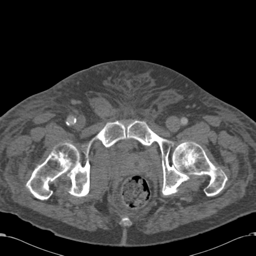 File:Abdominal hematoma (Radiopaedia 33614-34715 Axial C+ portal venous phase 131).png