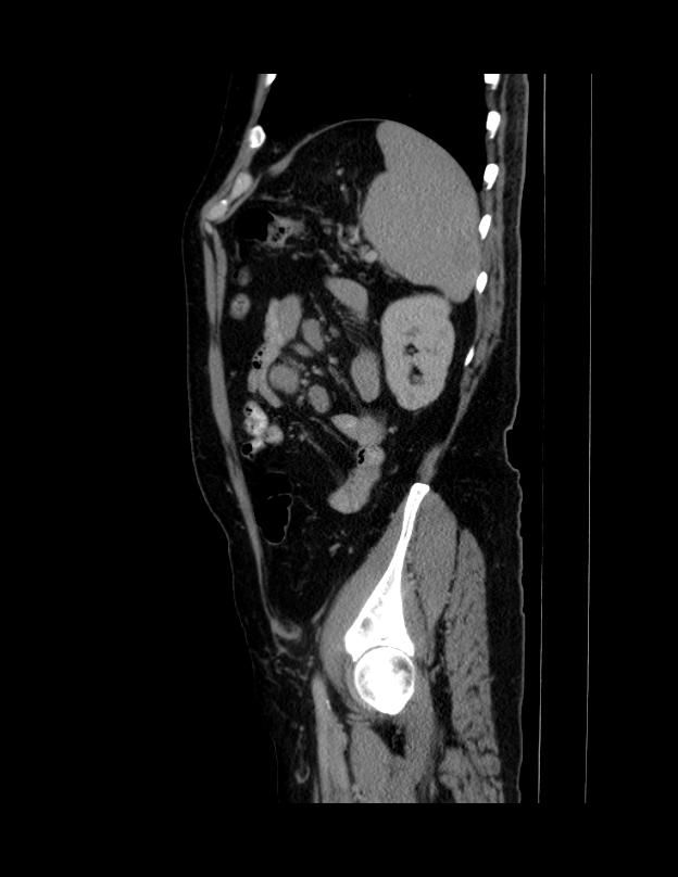 Abdominal lymphoma - with sandwich sign (Radiopaedia 53486-59492 Sagittal C+ portal venous phase 16).jpg