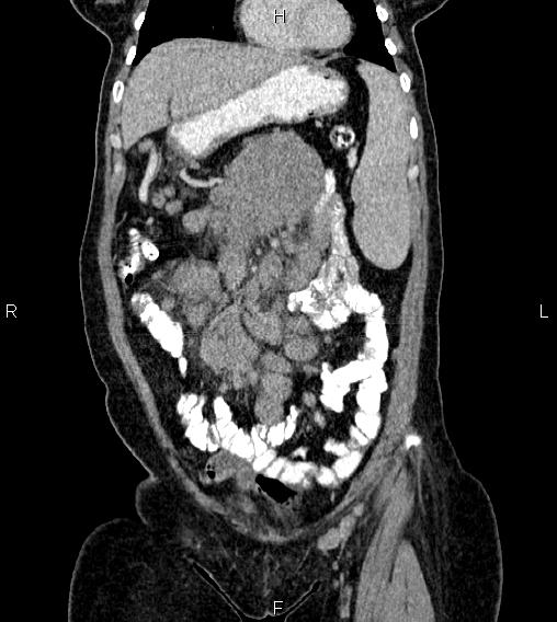 Abdominal lymphoma with sandwich sign (Radiopaedia 84378-99704 Coronal C+ portal venous phase 12).jpg