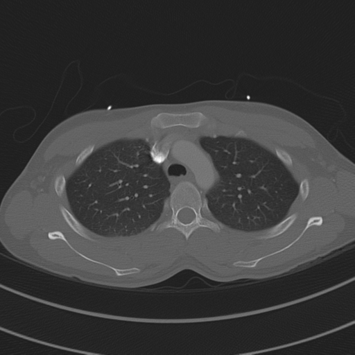 File:Abdominal multi-trauma - devascularised kidney and liver, spleen and pancreatic lacerations (Radiopaedia 34984-36486 I 25).png