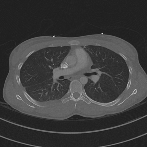 Abdominal multi-trauma - devascularised kidney and liver, spleen and pancreatic lacerations (Radiopaedia 34984-36486 I 39).png