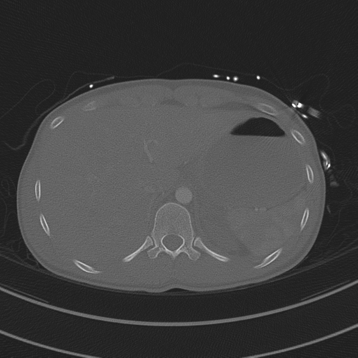 File:Abdominal multi-trauma - devascularised kidney and liver, spleen and pancreatic lacerations (Radiopaedia 34984-36486 I 81).png