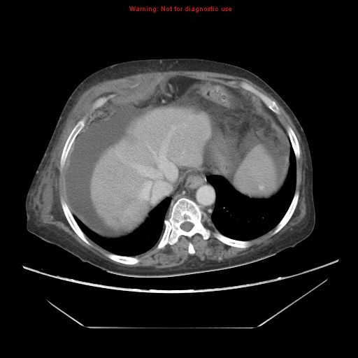 File:Abdominal wall hematoma (Radiopaedia 9427-10112 Axial C+ portal venous phase 19).jpg