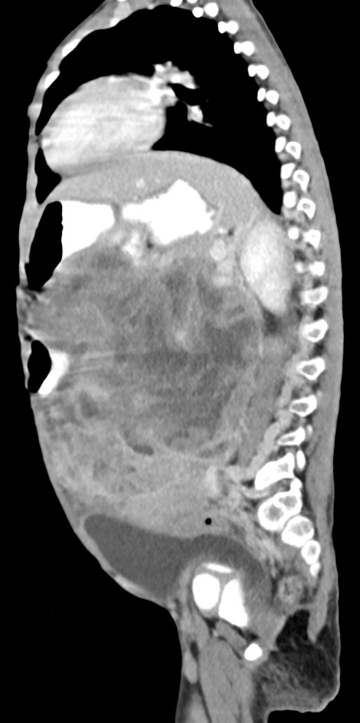 Abdominopelvic rhabdomyosarcoma (Radiopaedia 78356-90984 Sagittal C+ portal venous phase 36).jpg