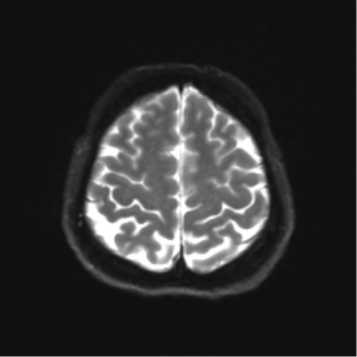File:Abducens nerve palsy (Radiopaedia 51069-56648 Axial DWI 22).png