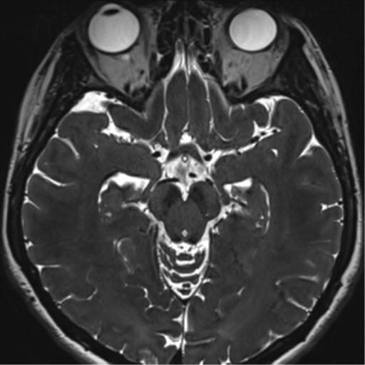 File:Abducens nerve palsy (Radiopaedia 51069-56648 Axial T2 fat sat 67).png