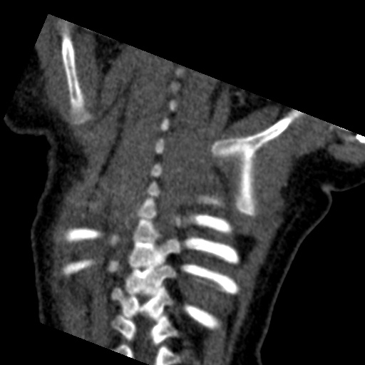 File:Aberrant left pulmonary artery (pulmonary sling) (Radiopaedia 42323-45435 Coronal C+ CTPA 2).jpg