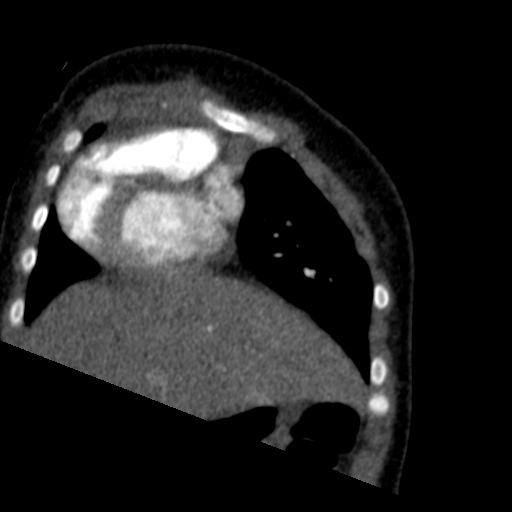 File:Aberrant left pulmonary artery (pulmonary sling) (Radiopaedia 42323-45435 Coronal C+ CTPA 21).jpg