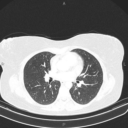 File:Aberrant right subclavian artery (Radiopaedia 87334-103629 Axial lung window 35).jpg