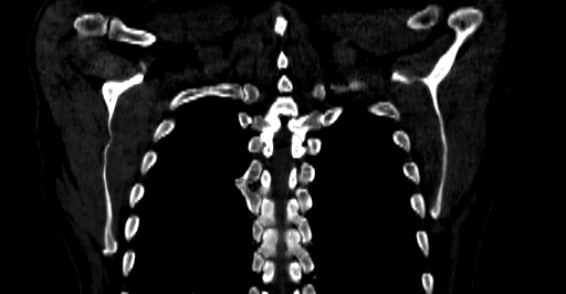 Accesory rib joint (Radiopaedia 71987-82452 Coronal bone window 57).jpg