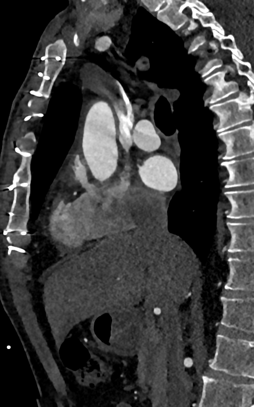 Accessory left atrial appendage (Radiopaedia 81987-95968 Sagittal C+ arterial phase 23).jpg