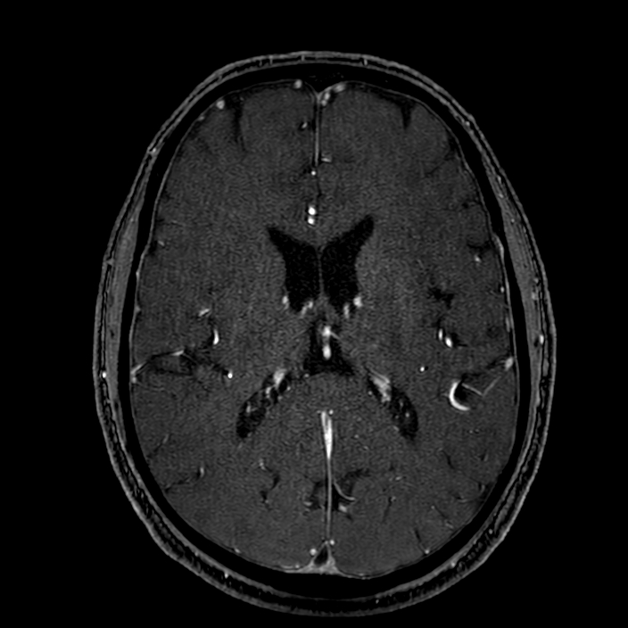 Accessory middle cerebral artery (Radiopaedia 73114-83828 Axial MRA 122).jpg