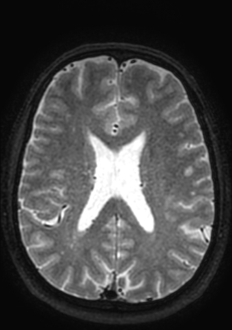 Accessory middle cerebral artery (Radiopaedia 73114-83828 Axial T2 30).jpg