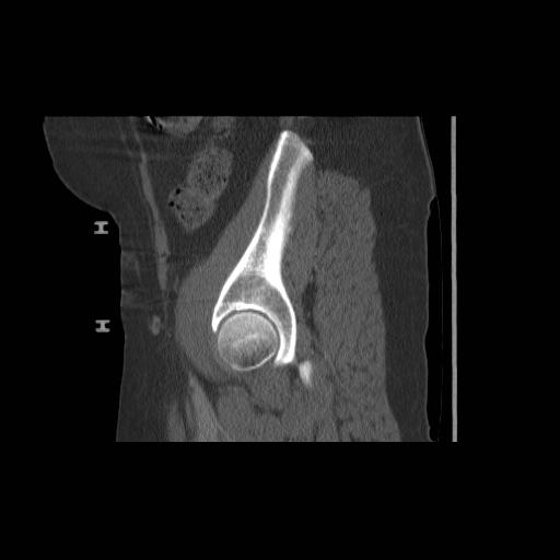 File:Acetabular fracture (Radiopaedia 13193-13212 Sagittal bone window 22).jpg