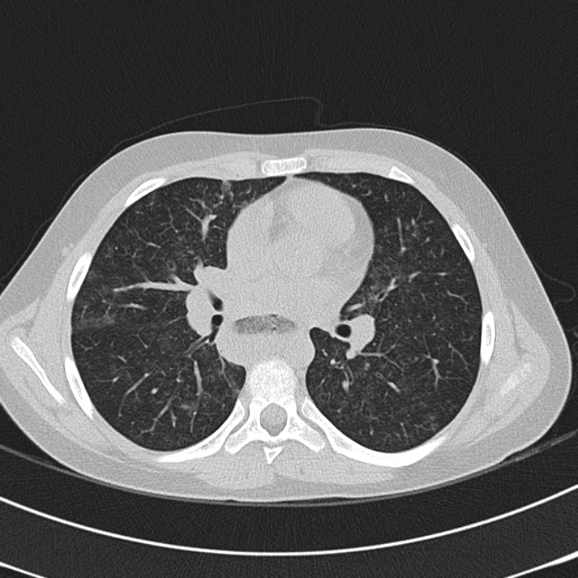 Achalasia (Radiopaedia 14946-14878 Axial lung window 38).jpg
