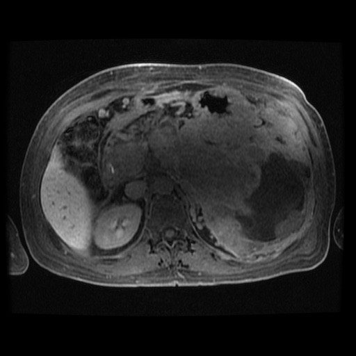 Acinar cell carcinoma of the pancreas (Radiopaedia 75442-86668 Axial late phase (~30 mins) 65).jpg