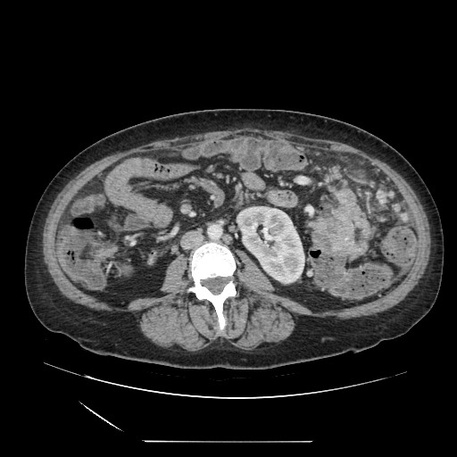 Acinar cell carcinoma of the pancreas (Radiopaedia 75442-86669 Axial C+ portal venous phase 78).jpg