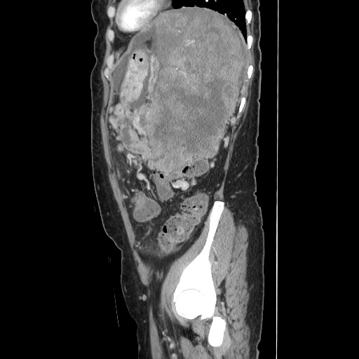 Acinar cell carcinoma of the pancreas (Radiopaedia 75442-86669 Sagittal C+ portal venous phase 144).jpg