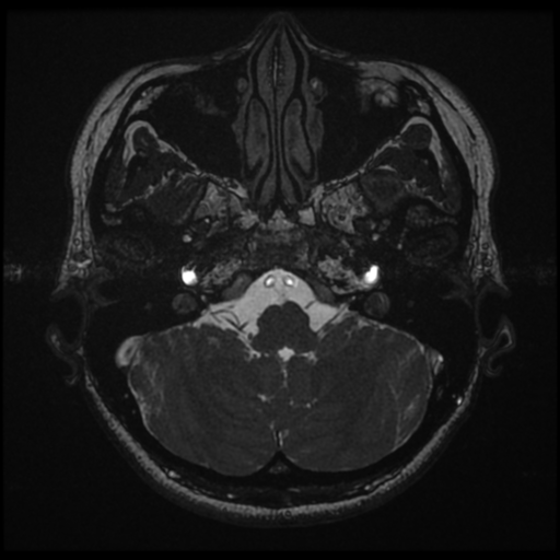 Acoustic neuroma (Radiopaedia 34049-35283 Axial 32).png
