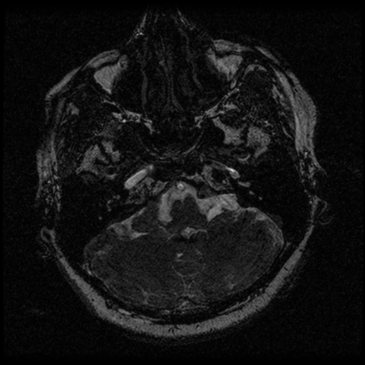 Acoustic schwannoma (Radiopaedia 33045-34060 Axial T2 13).png