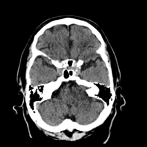 File:Acoustic schwannoma (Radiopaedia 55729-62280 Axial non-contrast 10).png