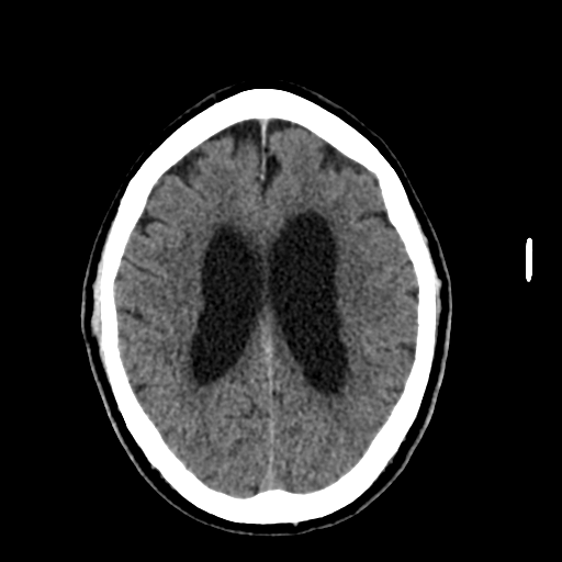 File:Acoustic schwannoma (Radiopaedia 55729-62280 Axial non-contrast 23).png