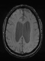 Acoustic schwannoma (Radiopaedia 55729-62281 Axial SWI 35).png