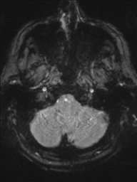 Acoustic schwannoma (Radiopaedia 55729-62281 Axial SWI 6).png