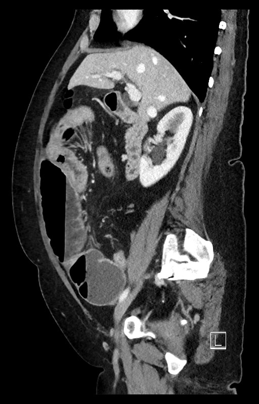 Active Crohn disease (Radiopaedia 59394-66750 Sagittal C+ portal venous phase 37).jpg