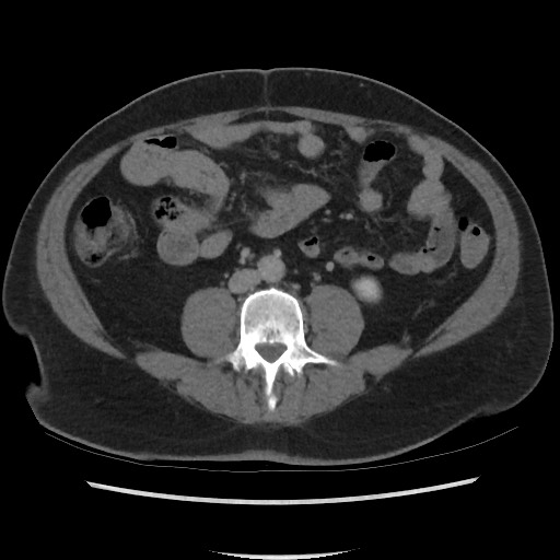 File:Active colonic bleed on CT (Radiopaedia 49765-55025 Axial C+ delayed 47).jpg