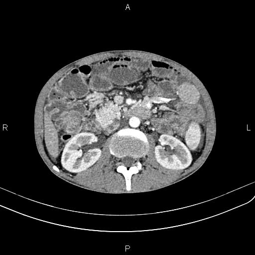 Active crohn disease (Radiopaedia 87133-103397 Axial C+ arterial phase 46).jpg