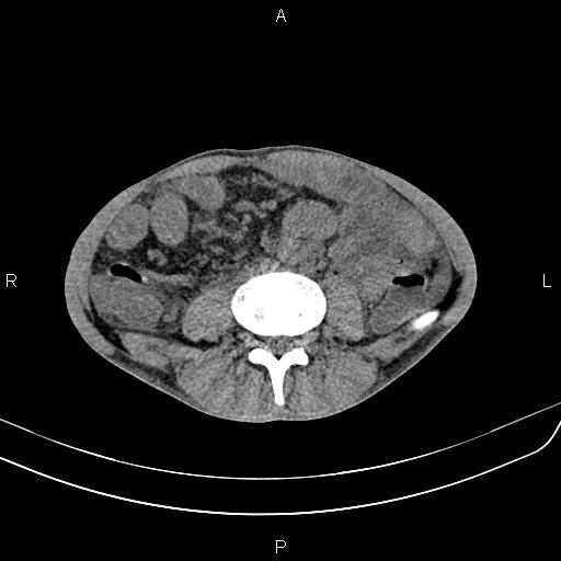 Active crohn disease (Radiopaedia 87133-103397 Axial non-contrast 61).jpg