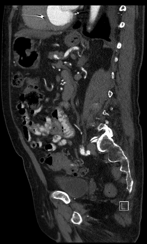 Active lower gastrointestinal bleeding - diverticular (Radiopaedia 61203-69106 Sagittal C+ arterial phase 66).jpg