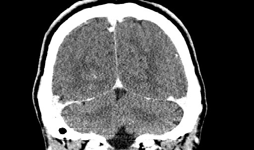 File:Active neurocysticercosis before and after therapy (Radiopaedia 71710-82099 Coronal 34).jpg