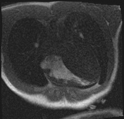 Active right ventricular cardiac sarcoidosis (Radiopaedia 55596-62100 Axial Dynamic perfusion scan MOCO 32).jpg