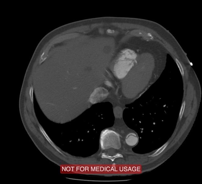 Acute aortic dissection - Stanford type A (Radiopaedia 40661-43285 Axial C+ arterial phase 58).jpg