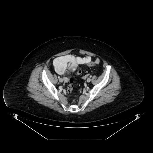 Acute appendicitis, heterotaxy syndrome (Radiopaedia 66884-76202 Axial C+ portal venous phase 105).jpg