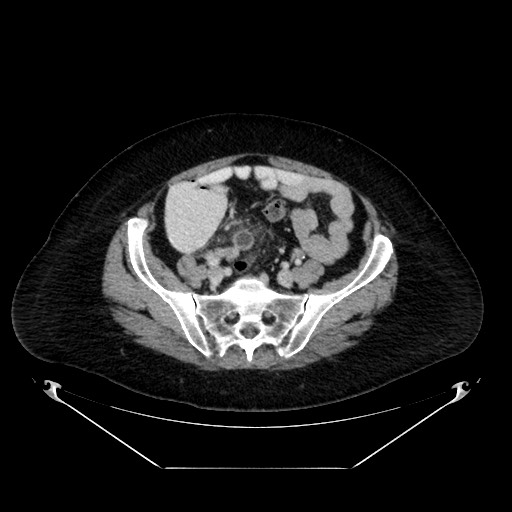 Acute appendicitis, heterotaxy syndrome (Radiopaedia 66884-76202 Axial C+ portal venous phase 95).jpg