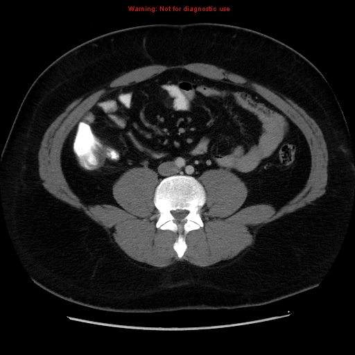File:Acute appendicitis (Radiopaedia 12326-12607 Axial C+ portal venous phase 9).jpg