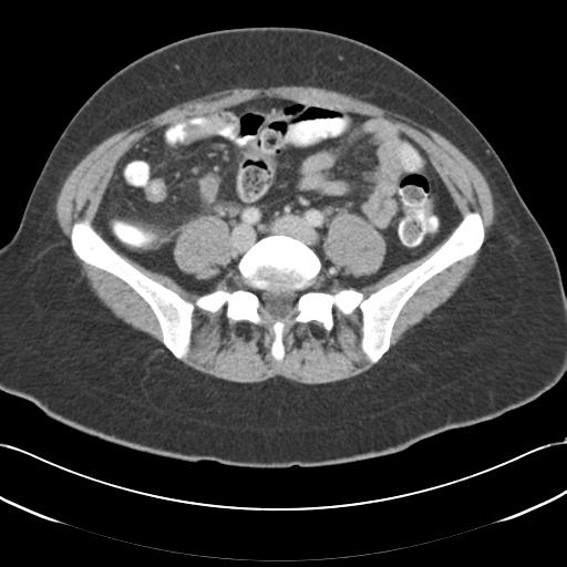 File:Acute appendicitis (Radiopaedia 30297-30934 Axial C+ portal venous phase 55).jpg
