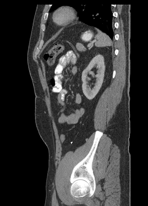 Acute appendicitis (Radiopaedia 48511-53463 Sagittal C+ portal venous phase 99).jpg
