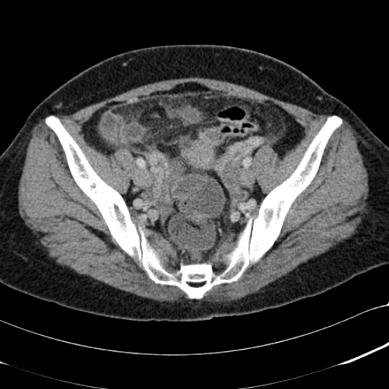 Acute appendicitis (Radiopaedia 48792-53822 Axial C+ portal venous phase 94).jpg