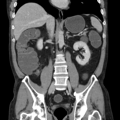 Acute appendicitis (Radiopaedia 66513-75790 Coronal C+ portal venous phase 48).jpg