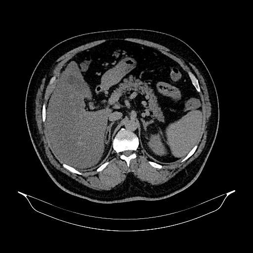 Acute appendicitis (Radiopaedia 79950-93224 Axial non-contrast 31).jpg