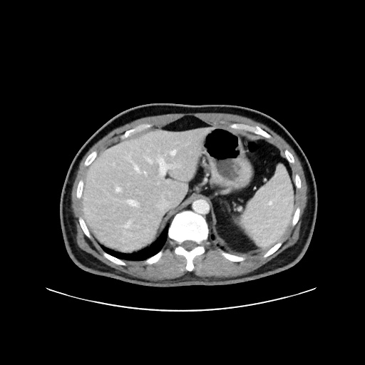 Acute appendicitis and COVID 19 pneumonia (Radiopaedia 76604-88380 Axial C+ portal venous phase 17).jpg