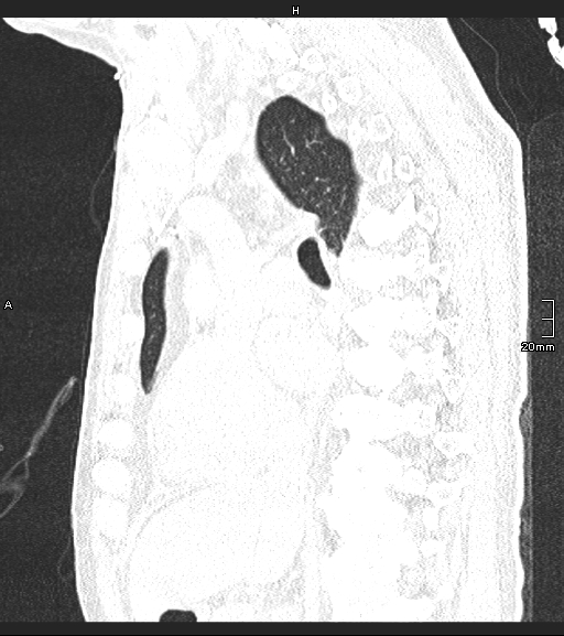 Acute aspiration pneumonitis (Radiopaedia 55642-62166 Sagittal lung window 87).jpg