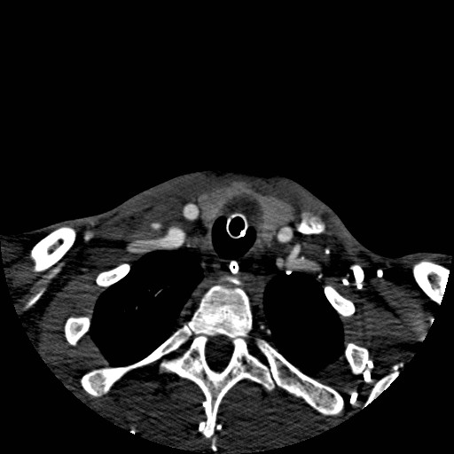 Acute basilar artery occlusion (Radiopaedia 43582-46985 Axial C+ arterial phase 287).jpg