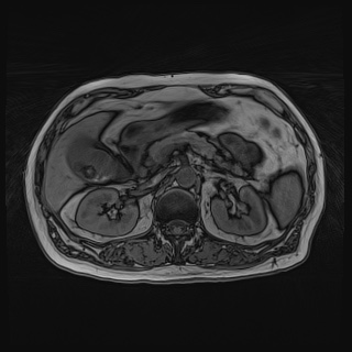 File:Acute cholecystitis (Radiopaedia 72392-82923 Axial T1 out-of-phase 55).jpg