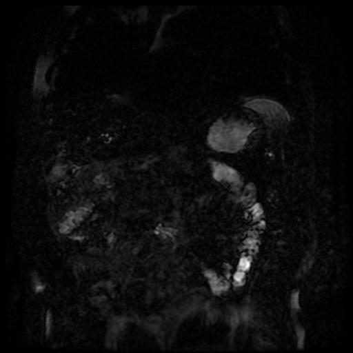 Acute cholecystitis and biliary hamartomas (Radiopaedia 86231-102240 E 129).jpg