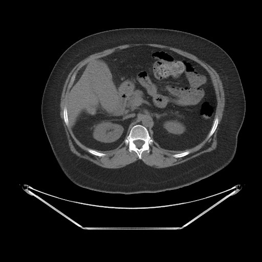 File:Acute cholecystitis with tensile fundus sign (Radiopaedia 71394-81723 Axial non-contrast 21).jpg